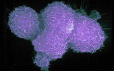 Tập thể dục thường xuyên có thể ngăn ung thư tuyến tiền liệt