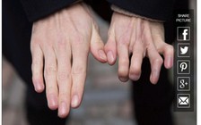 Kỳ lạ người đàn ông có hai ngón chân ở bàn tay