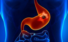 WCRF: Uống nhiều bia rượu làm tăng nguy cơ ung thư dạ dày