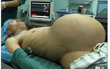Cắt bỏ khối u 'khủng' nằm trong bụng 10 năm