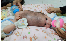 Ca sinh 3, 2 bé dính liền đầu ở Indonesia