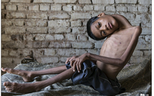 Phẫu thuật thành công cho cậu bé bị trẹo cổ ở góc 180 độ