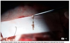 Gắp sán dây dài 7,5 cm ra khỏi não bé trai