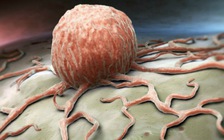 Hiểm họa 2 loại ung thư cùng tấn công người bệnh