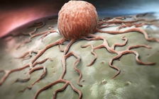 Cảnh báo ung thư tăng mạnh ở phụ nữ, nhiều nhất là ung thư vú