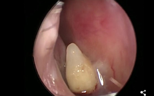 Sốc nặng khi biết răng mọc trong… hốc mũi