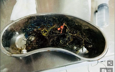 Phát hiện 1 kg gỗ và nhựa trong dạ dày chàng trai