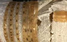 Bệnh nhân ‘kéo’ con sán dây dài gần 1,7 mét ra khỏi cơ thể