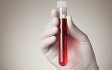 Phương pháp xét nghiệm máu mới giúp phát hiện sớm 8 loại ung thư
