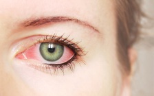 4 dấu hiệu bất thường ở mắt báo động sức khỏe bất ổn