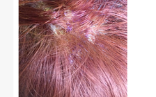 Cô gái bị bỏng da đầu khi nhuộm tóc ăn Tết