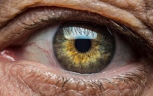 Người bị tiểu đường có nguy cơ đục thủy tinh thể cao