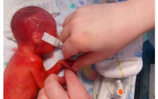 Bé gái sinh non đến mức nhìn thấy não dưới da vẫn sống sót kỳ diệu