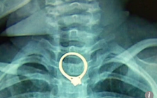 Mẹ bất cẩn, con cấp cứu vì nuốt chiếc nhẫn kim cương