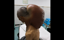 Cắt bỏ thành công khối u 'khủng' 15 kg sau cổ bệnh nhân