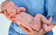 World Cup có thể khiến bệnh sởi lây lan khắp châu Âu