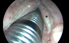 Nuốt nhầm viên thuốc tẩy, người đàn ông bị thối rữa cổ họng