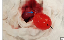 Bác sĩ cũng sốc: Bong bóng nước mắc kẹt trong... ruột chàng trai