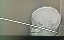 Cậu bé bị cây xiên thịt 30 cm đâm xuyên đầu vẫn sống sót