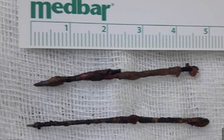 2 cây kim lọt vào dạ dày bệnh nhân, 66 năm sau mới được lấy ra