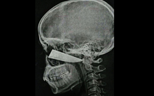 Cứu sống chàng trai bị lưỡi dao đâm sâu 10 cm vào mặt