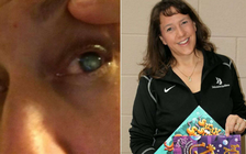 Đeo kính áp tròng khi bơi, người phụ nữ suýt bị mù 1 mắt