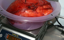 Khối u 'khủng' nằm trong bụng người phụ nữ suốt 13 năm