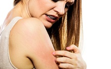 5 kiểu ngứa da là dấu hiệu của bệnh nghiêm trọng