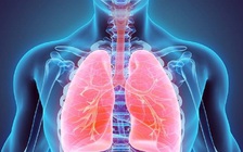 Vì sao mắc viêm phổi có thể gây tử vong nếu chủ quan?