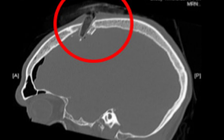 Tai nạn khó tin: Lướt sóng, bị mảnh vỡ ván lướt đâm dính vào hộp sọ