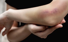 Mẹo sơ cứu những thương tổn thường gặp mà không cần đến bác sĩ