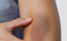 Tại sao da lại dễ bị bầm tím?