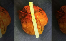 Người phụ nữ 'như bị ma ám' vì khối u buồng trứng