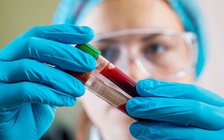 Xét nghiệm máu có thể chẩn đoán sớm ung thư phổi