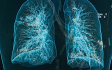 4 loại bệnh làm tăng nguy cơ đau tim, đột quỵ