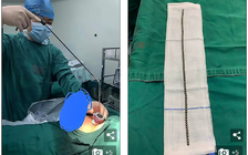 Cậu bé chơi dại nhét 70 viên bi nhỏ vào 'của quý'