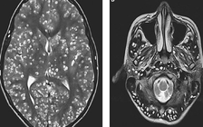Ăn thịt heo chưa nấu chín, chàng trai tử vong do sán xâm chiếm hết não