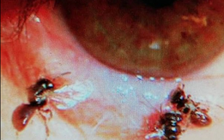 Cô gái bị 4 con ong chui vào mắt để... hút nước mắt