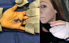 Cắt trái bơ, vô tình cắt luôn dây thần kinh và động mạch tay