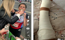 Bác sĩ cũng sốc: Bị gãy xương mắt cá chân, cô gái vẫn chạy thêm 29 km