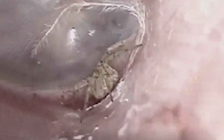 Bác sĩ cũng sốc: Phát hiện con nhện đang giăng tơ trong tai chàng trai