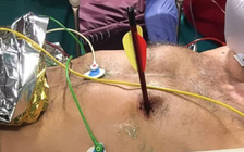 Bị bắn tên bắn trúng tim và phổi, người đàn ông vẫn sống