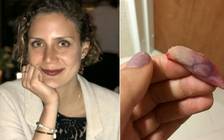 Cô gái bị khó thở suốt 9 năm do khối thịt to nằm trong mũi