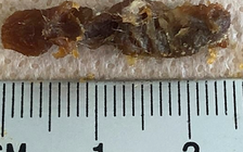 Bác sĩ và bệnh nhân cùng sốc: Lấy ra cục ráy dài 2,5 cm!