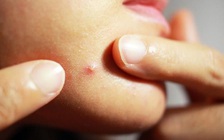 Phải làm gì khi mụn trứng cá nổi ngay cằm?