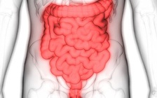 Bác sĩ cũng sốc: Ruột thắt thành nút, phải cắt bỏ 90 cm vì hoại tử