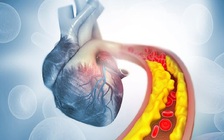 Giảm 300 calo/ngày rất tốt cho tim mạch, kể cả đối với người có cân nặng khỏe mạnh