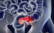 Cảnh báo ung thư đại trực tràng ở tuổi 20