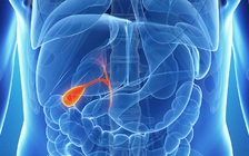 Bác sĩ cũng sốc: Lấy gần 2.000 viên sỏi mật ra khỏi cơ thể người phụ nữ