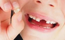 Va chạm khi đá bóng, một chiếc răng cắm vào... hộp sọ cậu bé